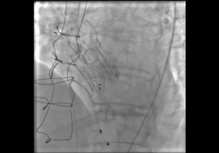 An elderly woman underwent ViV #TAVR for bioprosthetic valve dysfunction with high bilateral coronary obstruction risk. Simultaneous bileaflet modification and LLAMACORN modification enabled a successful outcome. #JACCCaseReports