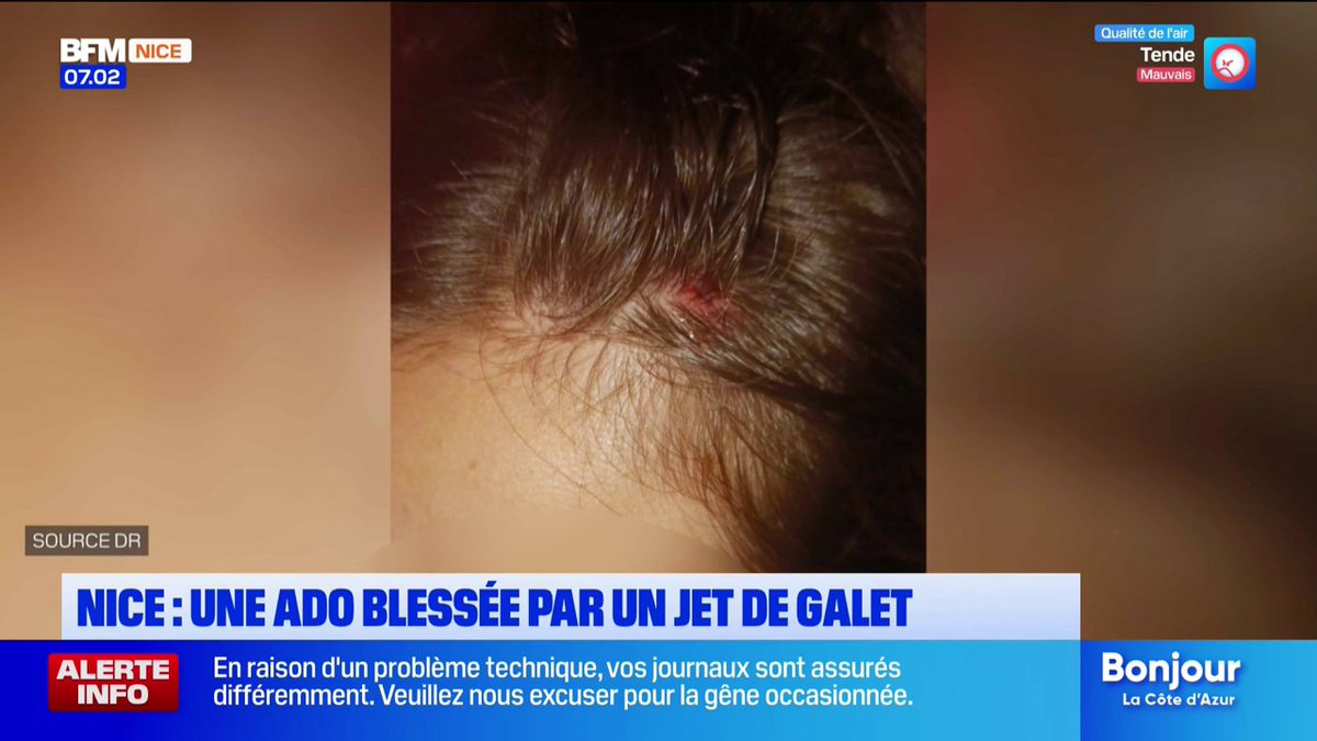 « Elle souffre de migraines incessantes » : à Nice, Louane, 17 ans, blessée à la tête par un jet de galet, raconte son agression