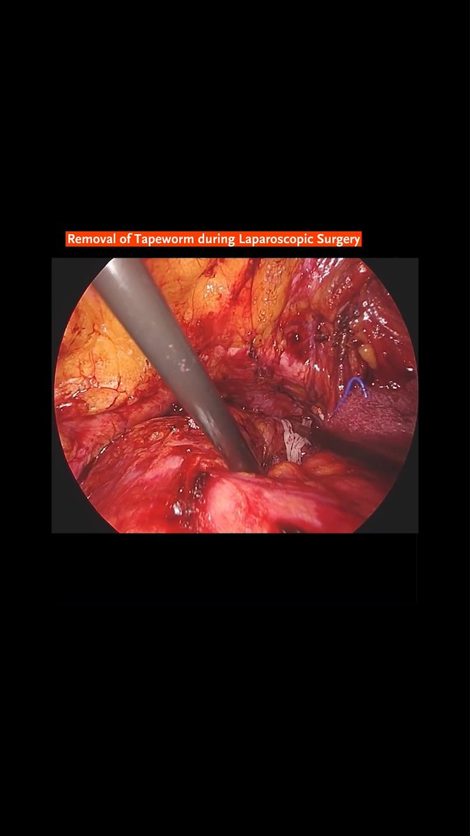 A 71-year-old man was found to have a tapeworm (shown in a video) in his peritoneal cavity during elective repair of a right inguinal hernia. He recalled having consumed raw snake meat during his military service 50 years earlier. Read the full case presentation: