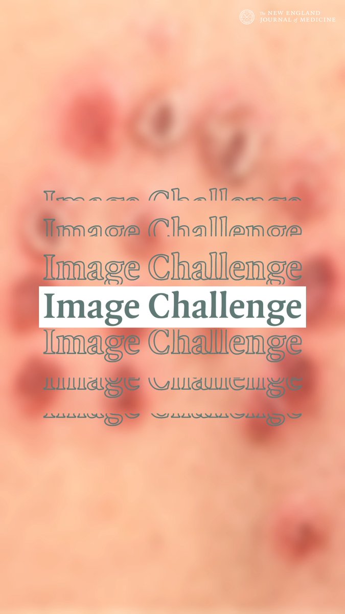 A 35-year-old man with a history of moderate-to-severe plaque psoriasis presented to the dermatology clinic with new skin lesions. His psoriasis had been in remission for the past 18 months while on risankizumab. Two weeks before presentation, the patient had undergone his first ever session of wet cupping therapy to treat low back pain. During the treatment, clusters of small incisions had been made at different sites across his back, after which glass cups had been applied with negative pressure to draw out small amounts of blood. What is the most likely diagnosis? Submit your answer and see how others responded: