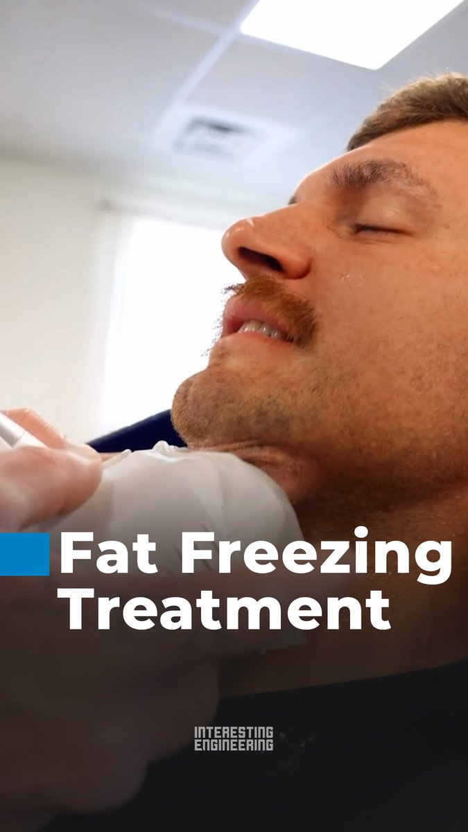 Cryolipolysis uses controlled cooling to target localized fat cells without surgery. Over the following weeks, the body naturally removes the treated fat cells, gradually improving body contours with minimal downtime. 🎥 theebodygarage / IG