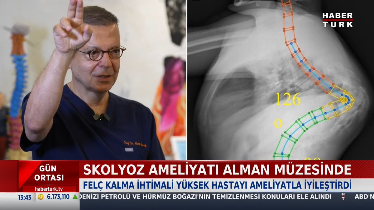 Riskli ameliyat tıp tarihine geçti: "Hasta ameliyatta 25 dakika felç kaldı" Prof. Dr. Ahmet Alanay'ın başarısı Almanya'da müzede sergileniyor.