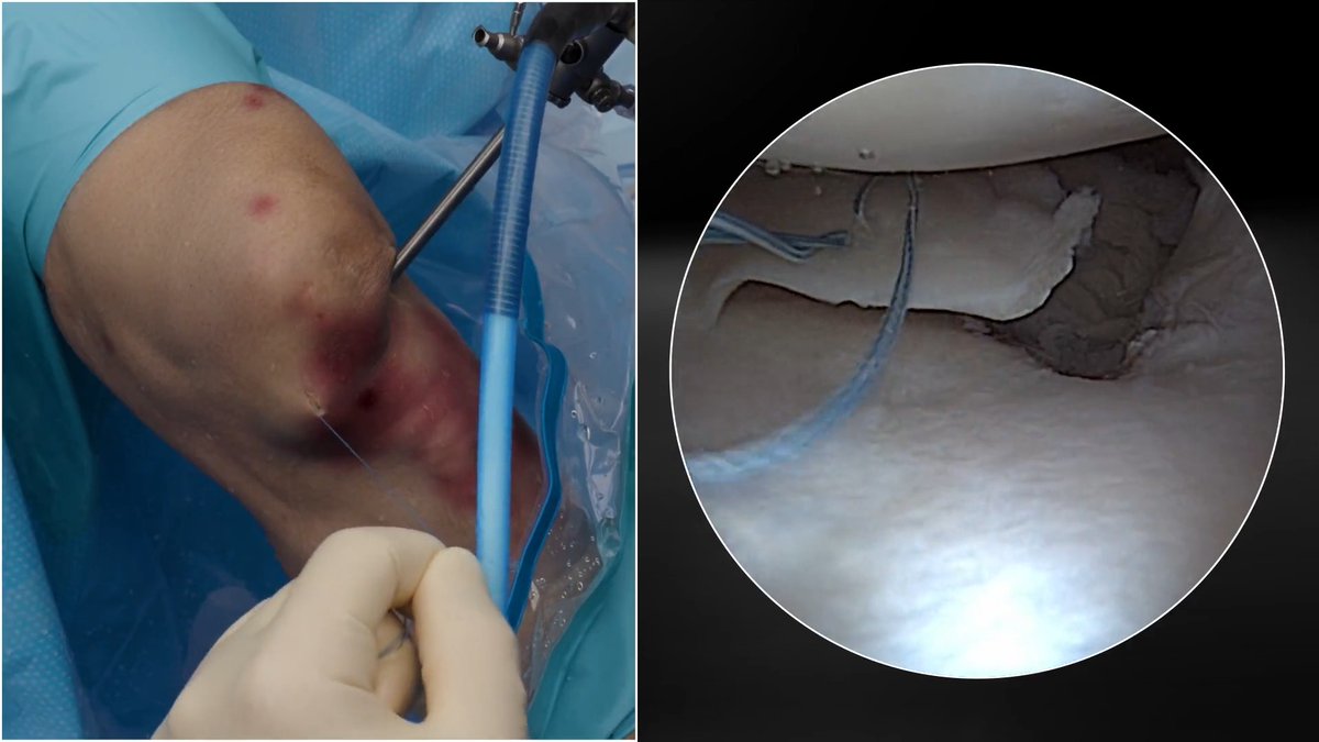 Aaron J. Krych, MD, demonstrates meniscal root repair using the SutureLoc™ implant and a FiberStitch™ 1.5 implant to augment the repair. Watch the full video: #Arthrex