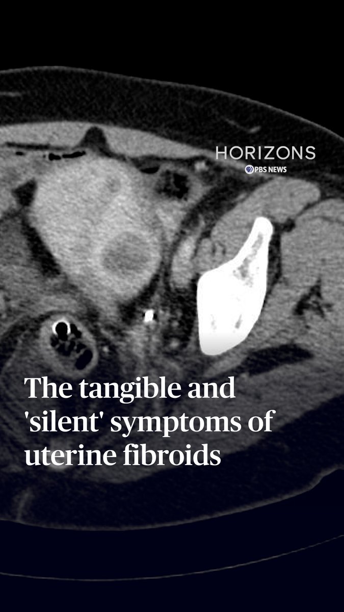 Fibroids are tumors that grow on or in the wall of the uterus, and about 70% to 80% of women will have them in their lifetime. Black women suffer the most. But fibroids are widely misunderstood and poorly researched. Federal research about fibroids receives far less money compared to other conditions like prostate or breast cancer. While fibroids start small, they can grow to be very large — as big as a grapefruit, or even a watermelon. They are not cancerous, but they can wreak as much havoc as cancer by causing severe bleeding, anemia, pain and complicating the ability to have children. Host William Brangham discussed what they are and how they develop with Dr. Soyini Hawkins, a gynecologist and surgeon who founded the Fibroid and Pelvic Wellness Center of Georgia. Horizons from PBS News, dives into the science, health, technology and environmental issues making headlines each week. Visit the PBS News website to watch this week's episode.