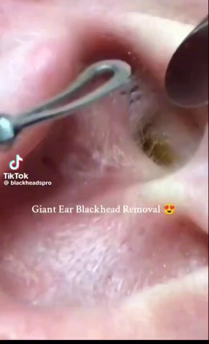 شخص اعتاد تنظيف أذنه بأعواد القطن معتقداً أنها الطريقة الصحيحة لكن مع مرور الوقت بدأ يعاني من انسداد وضعف في السمع فقرر أخيراً زيارة الطبيب لمعرفة السبب لكن ما اكتشفه أثناء الفحص كان أغرب بكثير مما توقع وجعل الجميع في حالة من الدهشه