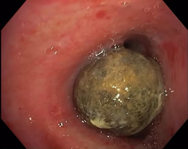 Following accidental airway aspiration of this pea-shaped object, a bronchoscopy was performed for retrieval. You won’t believe the first removal technique…
