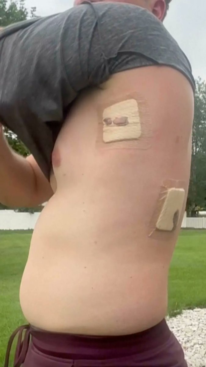 David Cifaldi was approaching the top of Montana’s highest peak with two friends when he slipped and impaled himself on his trekking pole. Worried about the high cost of a helicopter rescue, Cifaldi and his companions hiked out the 10 miles to a trailhead with the pole still impaled.