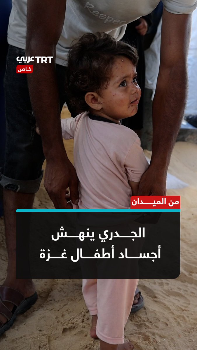 جدة الطفلتين تروي لـTRT عربي معاناتهما مع الجدري داخل خيمة نزوح، حيث يفاقم غياب الدواء والظروف الإنسانية القاسية آلام الأطفال. TRT عربي.. #حكايات_من_الميدان