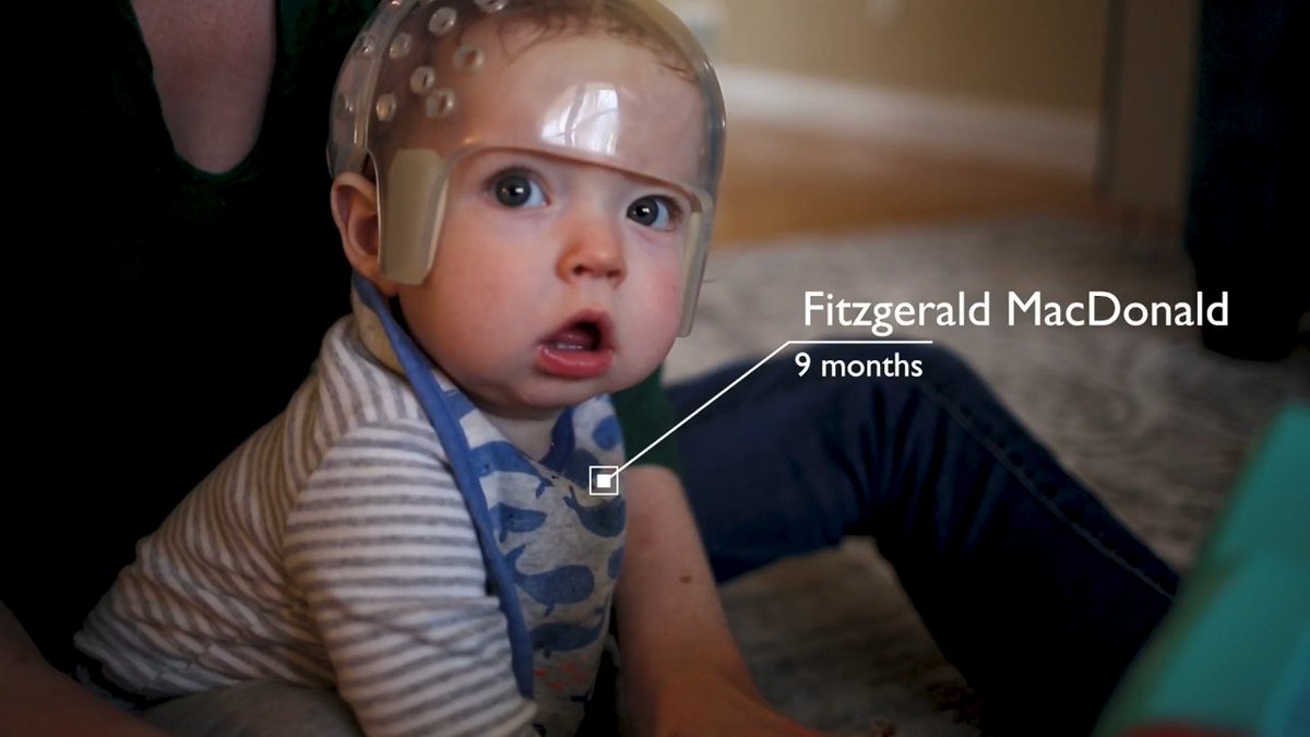 After a minimally invasive surgical approach to remove fused bone at Johns Hopkins Children's Center, followed by helmet therapy, Fitz' skull is growing into a normal shape. See his story below:
