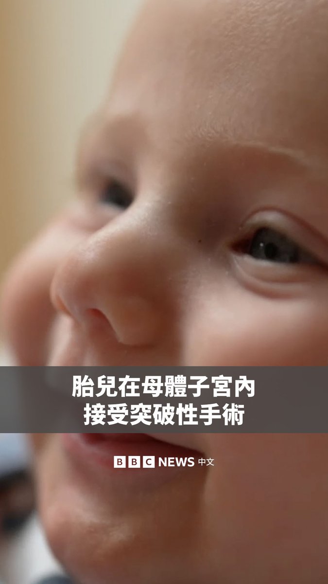 医师罕见地在胎儿仍在母体内时，透过突破性的手术成功矫正一项先天缺陷。来自伦敦的母亲梅茜·萨维奇在怀孕26周时，于美国接受医疗团队手术。 如今，五个月大的男婴西奥健康成长。他罹患的是腹裂症，也就是胎儿在发育时腹壁出现缺损，导致肠道暴露于腹腔外。