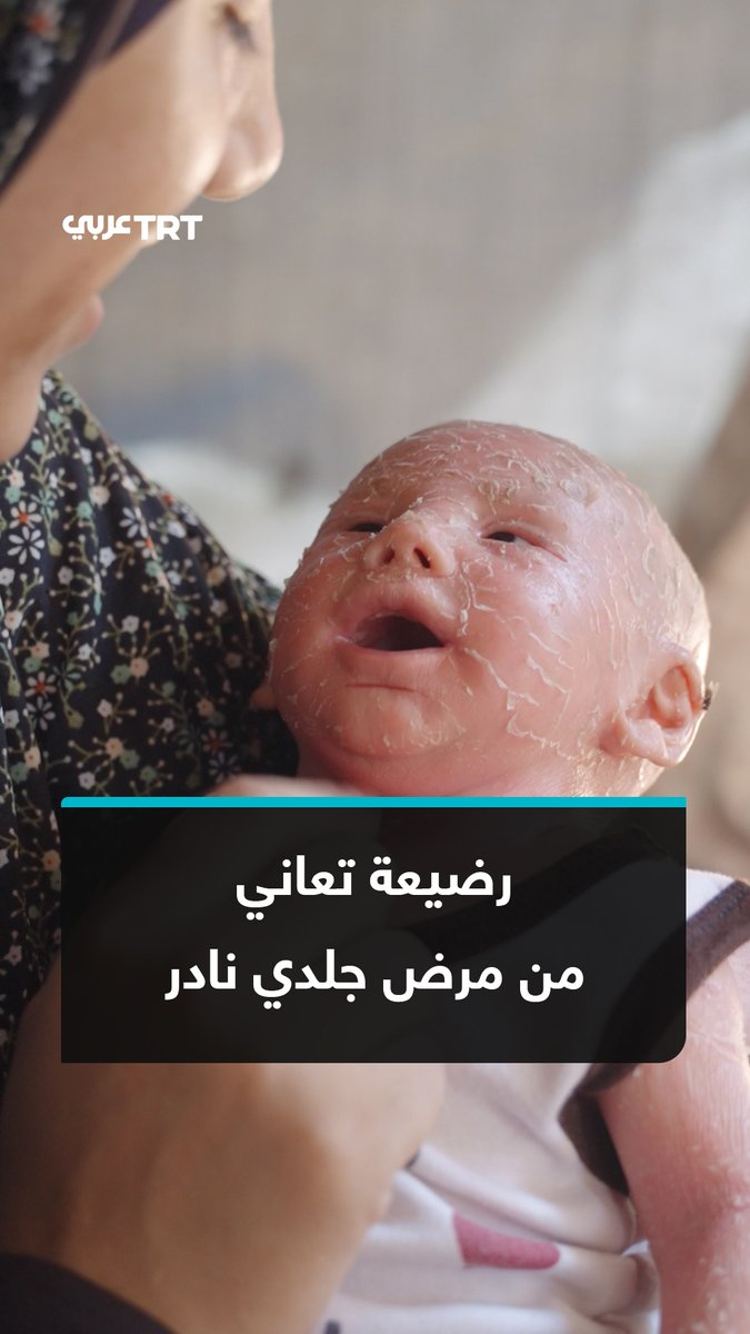 بعد أن ودَّعت طفلها الأول، تخشى أمٌّ فلسطينية أن تفقد طفلتها الثانية أيسل، التي تكافح مرضاً جلدياً وراثياً نادراً وسط نقص العلاج وتدهور الأوضاع الصحية في قطاع #غزة. TRT عربي.. #حكايات من الميدان