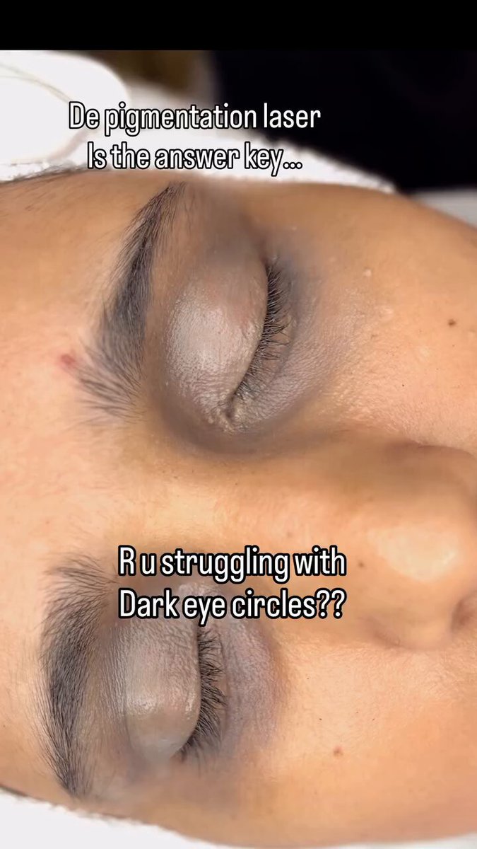 A pigmentation removal laser like this might be what you are looking for