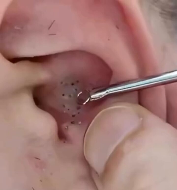 Blackhead extraction videos are basically free therapy. I said what I said. 😂