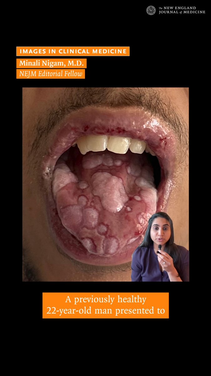 NEJM Editorial Fellow Minali Nigam, MD, describes the case of a 22-year-old man who presented with a 5-day history of painful lesions on his hands, feet, lips, and tongue. Physical examination showed erosions on the tongue and target lesions on the palms. Read the case details and diagnosis: