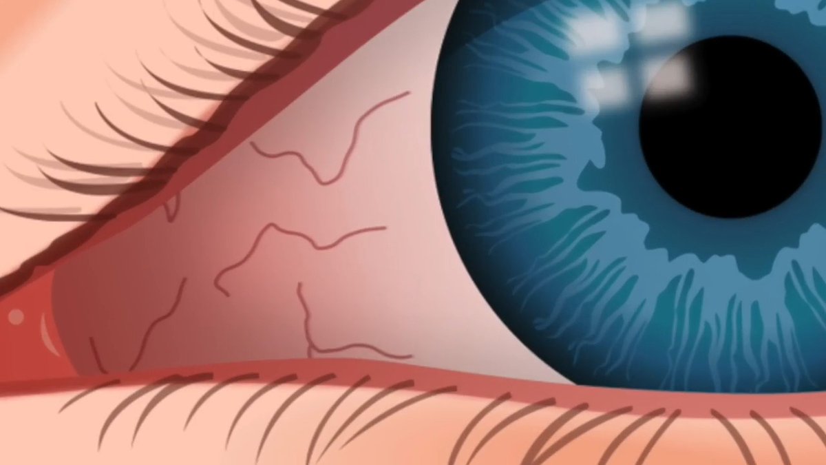 Discover the best natural remedies to get rid of eye floaters! If you like this video, check this one out next: Dr. Eric Berg, DC, not MD; information only