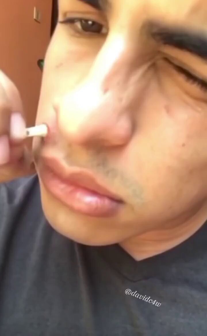 The black hair is finally out. Did he do it right by dragging it out or would a simple procedure been better? What do you think guys?