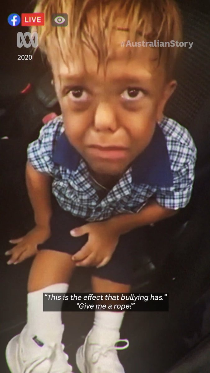 From a viral video about facing school bullying in 2020 to walking the red carpet in Hollywood! The story of Quaden Bayles, a young indigenous Australian kid with achondroplasia (a form of dwarfism) is one of the most remarkable and inspiring turnarounds in modern cinema history, leading directly to his feature film roles in George Miller's Three Thousand Years of Longing (2022) and Furiosa: A Mad Max Saga (2024).
