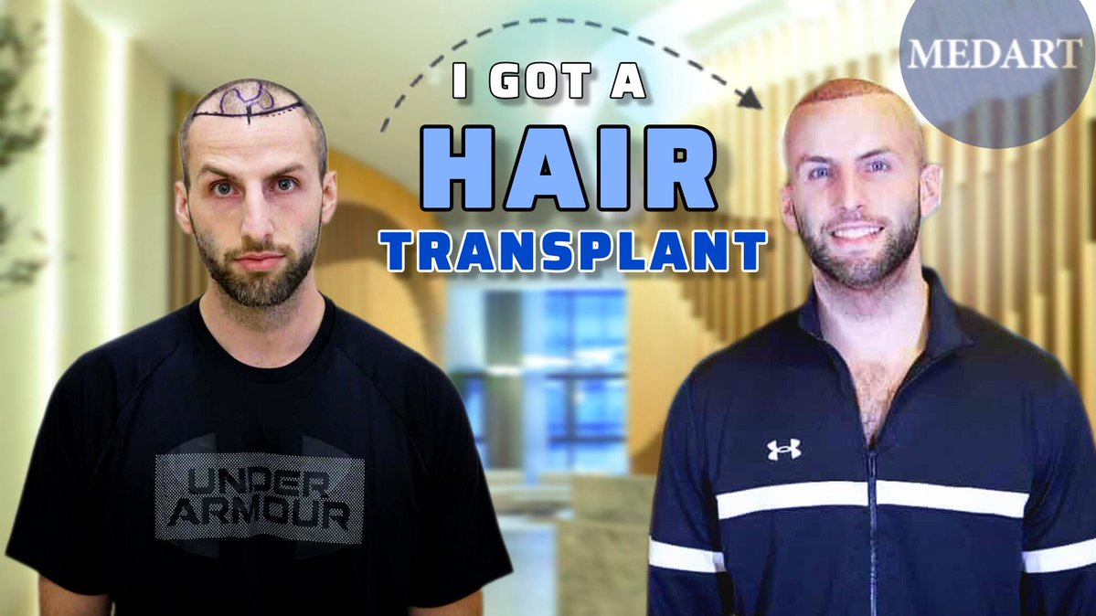 Come get a hair transplant in Turkey with me! 29 years old and fixing my hairline. 💈 #hairtransplant #hairloss #HairCare #balding #turkey