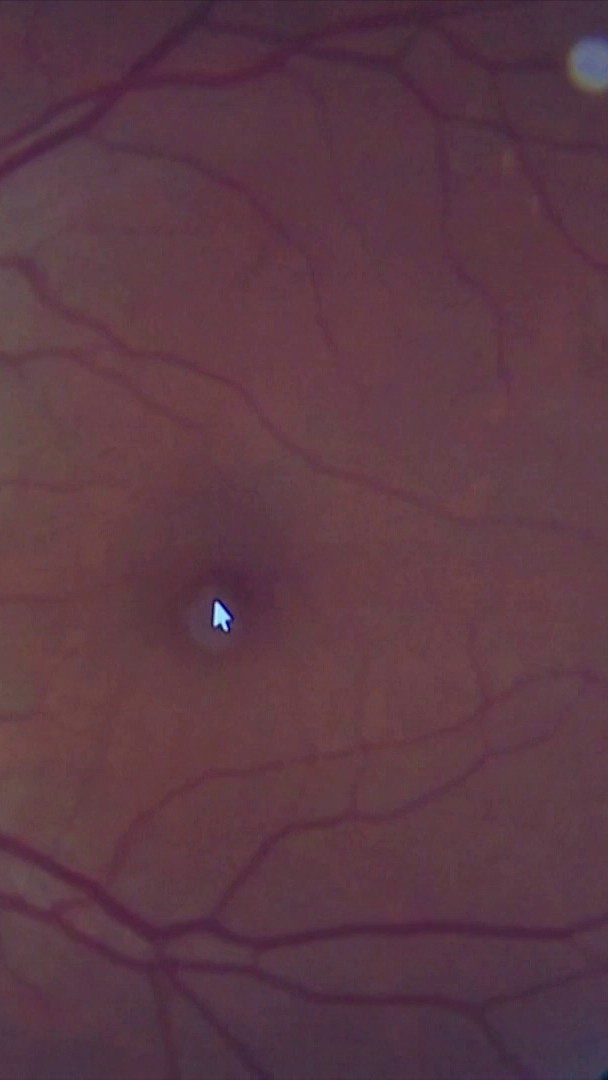 👁 Douleur à l'oeil, gêne visuelle... Si vous n'avez pas utilisé de lunettes adaptées pour regarder l'éclipse, il se pourrait que que vous ayez certains symptômes relevant de la rétinopathie solaire. #canal16