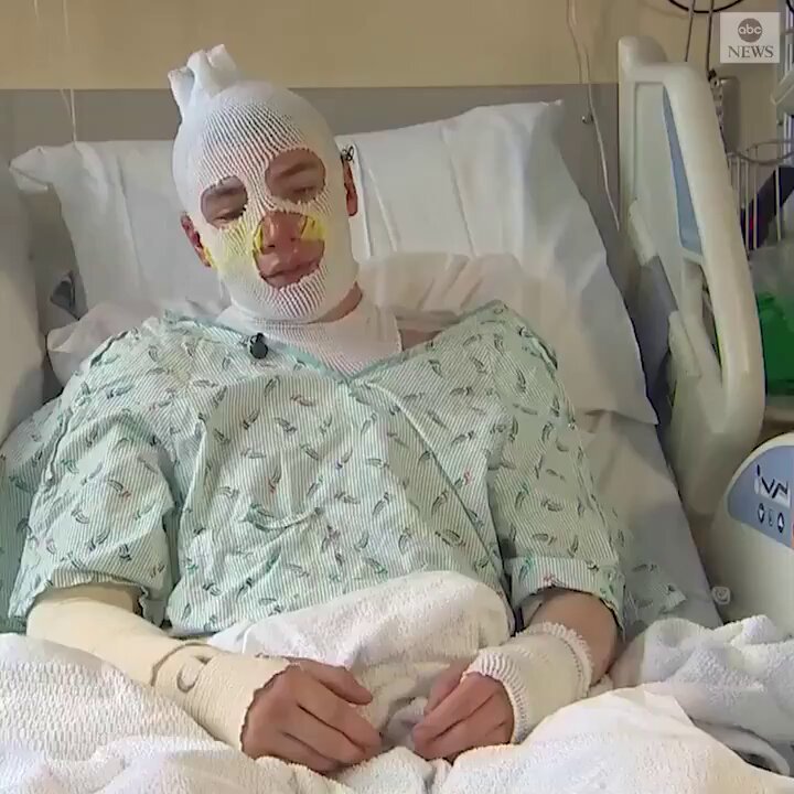 Human instinct tells you to run away from fire. ​Bone-deep love does the exact opposite. ​4:00 a.m. The house is roaring in Aberdeen, Washington. Derrick Byrd, just 20 years old, is already badly burned on the front lawn. He has just caught his baby niece and nephew dropping from the second story into his bare arms. ​Then he looks up. ​Eight-year-old Mercedes is still at the ledge. Paralyzed by pure terror. ​Before she can jump, the smoke swallows the room. She falls backward into the darkness, and through the roaring wall of heat, Derrick hears one sound that stops his heart: ​She is screaming his name. ​He doesn’t wait for sirens. He doesn’t look for gear. ​He sprints straight through the front door and charges up the burning staircase. ​Skin blistering. Flesh melting against the heat. Lungs searing on toxic black air. He doesn't slow down. He breaches the wall of flames on the second floor, grabs Mercedes, and rips off his own shirt to wrap around her face so the poison smoke won't touch her lungs. ​He shields her body with his own flesh and carries her into the street seconds before the entire roof caves in. ​He wakes up in a hospital bed—bandaged from head to toe, covered in severe second, third, and fourth-degree burns, battling catastrophic nerve damage. ​When they asked him why he did it, this 20-year-old didn't hesitate: ​“I’d run back in there and do it again. Even if I got burnt worse or died. I’d rather it be me than her. She’s young. She’s got a whole life ahead of her.” ​True courage isn't the absence of pain—it’s deciding that someone else’s life is worth every single scar.