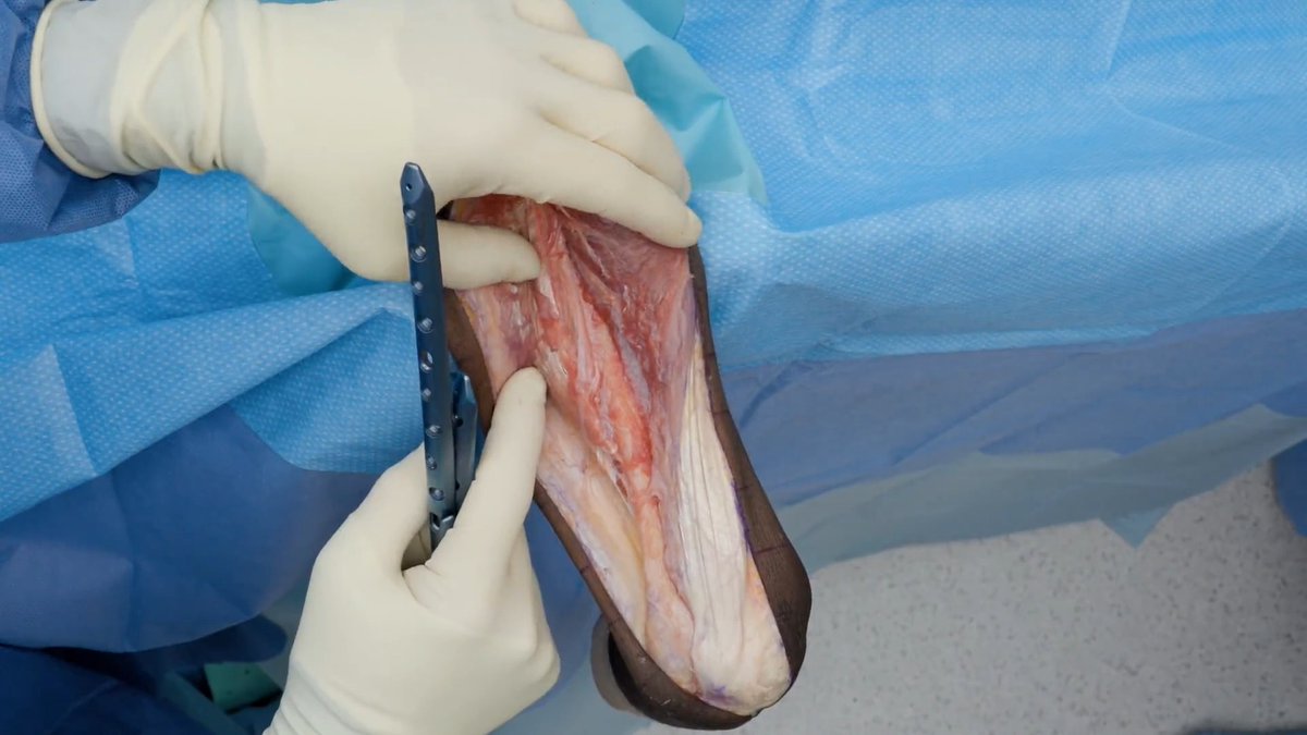Erik Kubiak, MD, presents the Arthrex extra-articular distal humerus plate for distal ⅓ shaft fracture fixation. The Arthrex Elbow Plating System provides a comprehensive solution for distal humerus and olecranon fracture fixation, using next-generation KreuLock™ locking compression screws. Dr. Kubiak has positioned the patient using the ElbowLOC® arm positioning system. Learn More: #WhatsNewAtArthrex