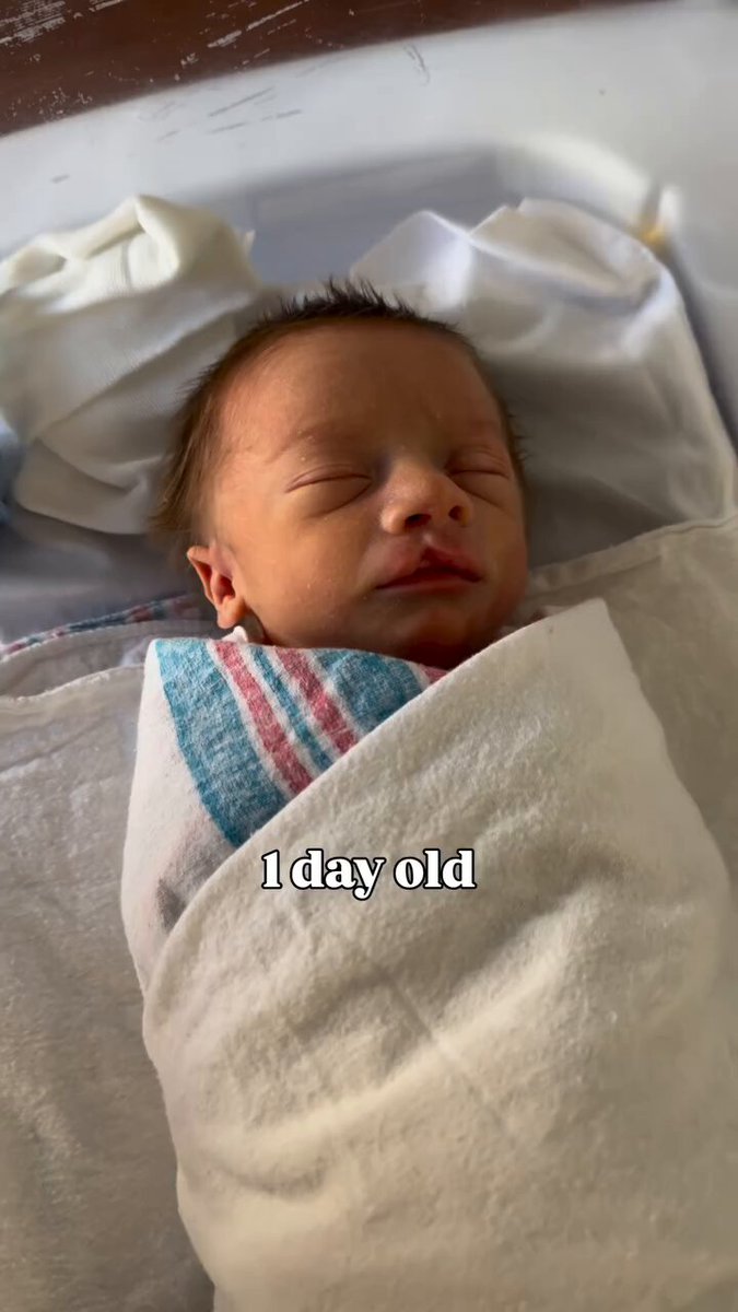 Cleft lip is one of the most common birth defects babies are prone to developing. Yet doctors have begun recommending abortion as the “solution” to this treatable condition. Here is a sweet baby boy before and after his cleft lip repair. Same person, same value, the only thing that changed was his smile.