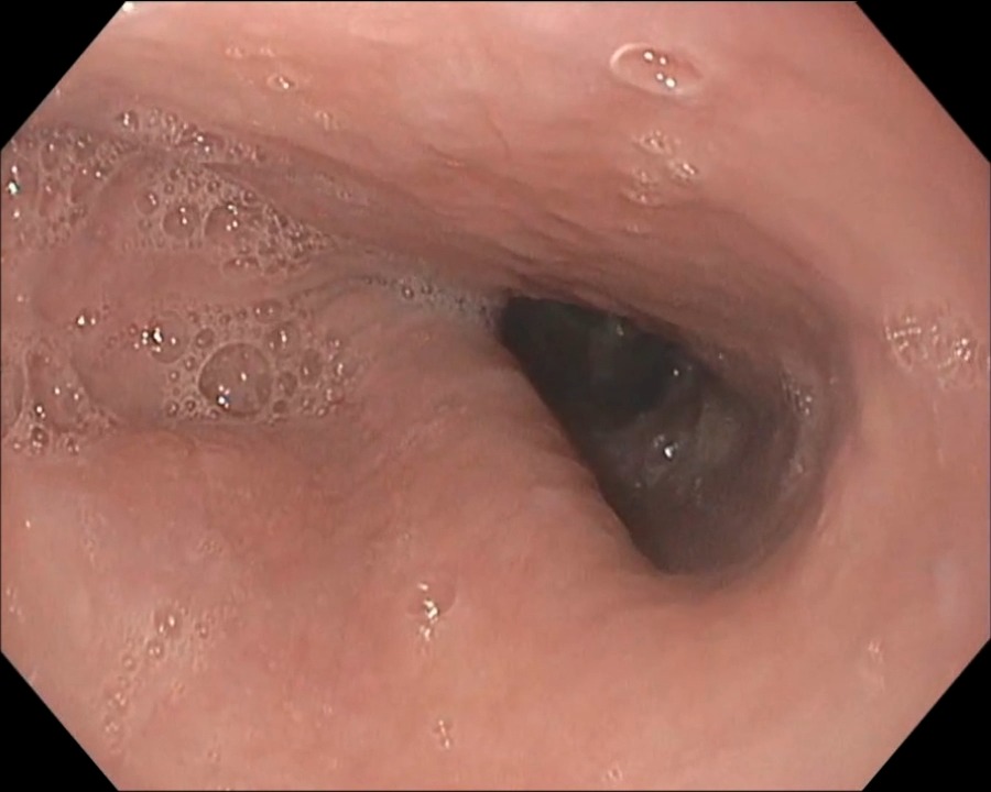 Endoscopy in a 44-year-old man with a 4-year history of choking episodes while eating revealed luminal narrowing of the upper esophagus by a pulsating, cordlike structure (arrow) in the posterior wall of the esophagus. Full case details: