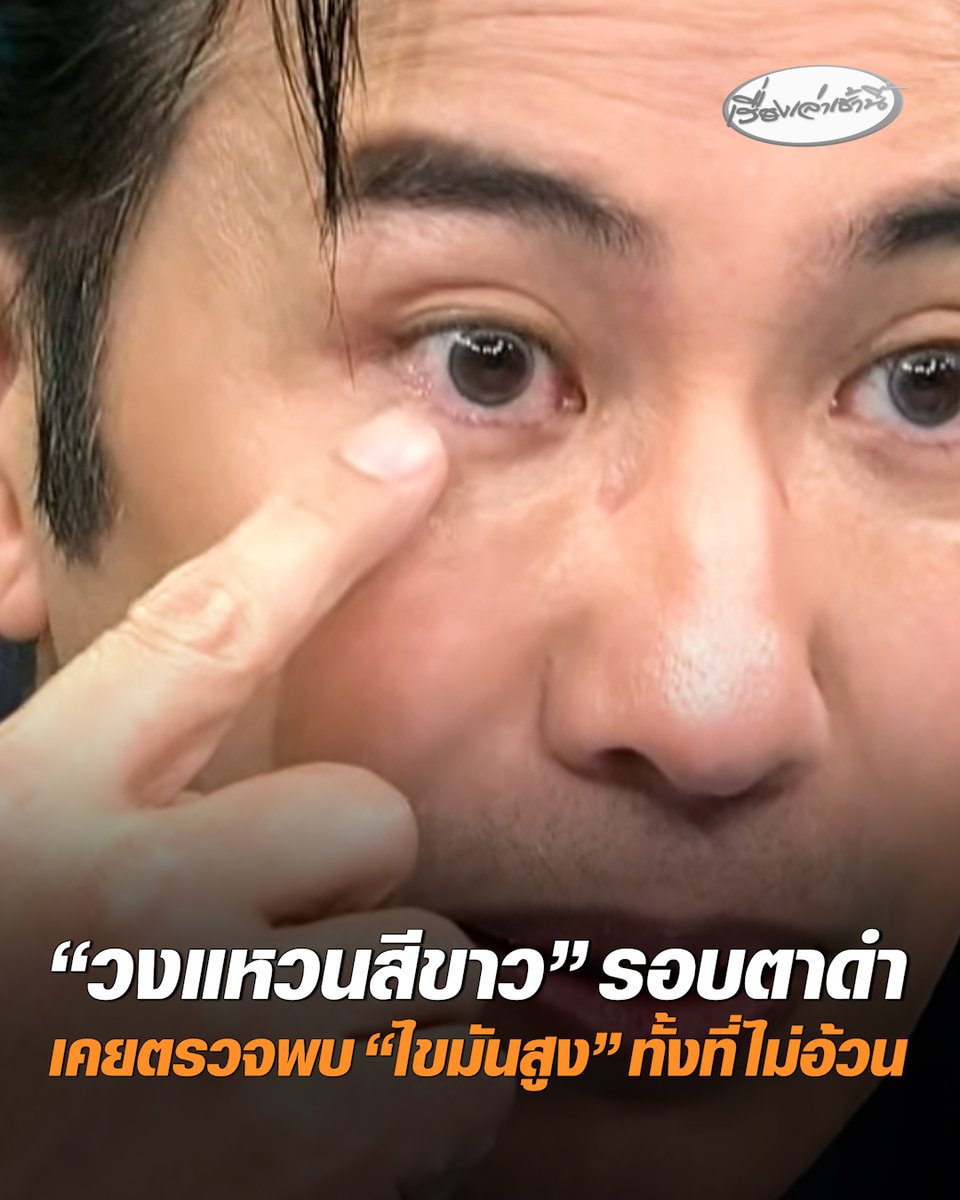 "หนุ่ม กรรชัย" เล่าประสบการณ์หาหมอเมื่อ 10 ปีที่แล้ว ตรวจพบไขมันเลว-คอเลสเตอรอลสูงลิ่ว ทั้งที่ไม่ได้อ้วน ทำให้ต้องเริ่มกินยามาโดยตลอด เผยจุดสังเกต มีเส้นขาวๆ เทาๆ รอบตาดำ ในคนที่อายุต่ำกว่า 40 ปี #เรื่องเล่าเช้านี้ #ครอบครัวข่าว3 #ArcusSenilis #ไขมัน #คอเลสเตอรอล