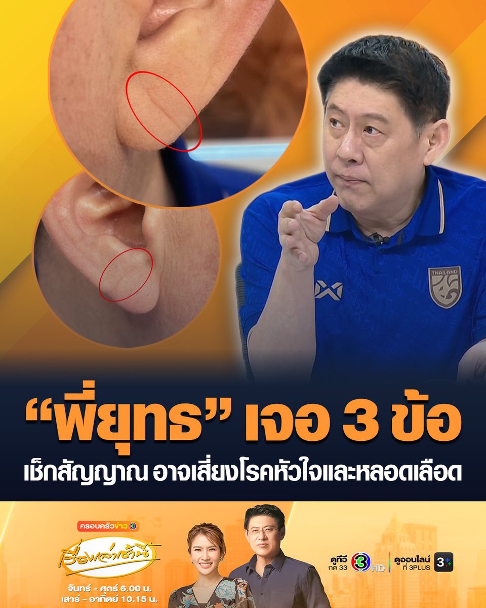 #เรื่องเล่าเช้านี้ สถาบันโรคทรวงอก เผย 10 สัญญาณ อาจบ่งบอกความเสี่ยงโรคหัวใจและหลอดเลือด “สรยุทธ” เผยเจอ 3 ข้อ ด้านแพทย์ชี้รอยพับติ่งหูไม่ได้บอกโรคหัวใจตรงๆ แต่เป็นการเตือนภาวะไขมันสูง สัญญาณเตือนหลอดเลือดเสื่อม #ข่าวช่อง3 #โรคหัวใจ #หลอดเลือดหัวใจ #สรยุทธ #รอยพับติ่งหู