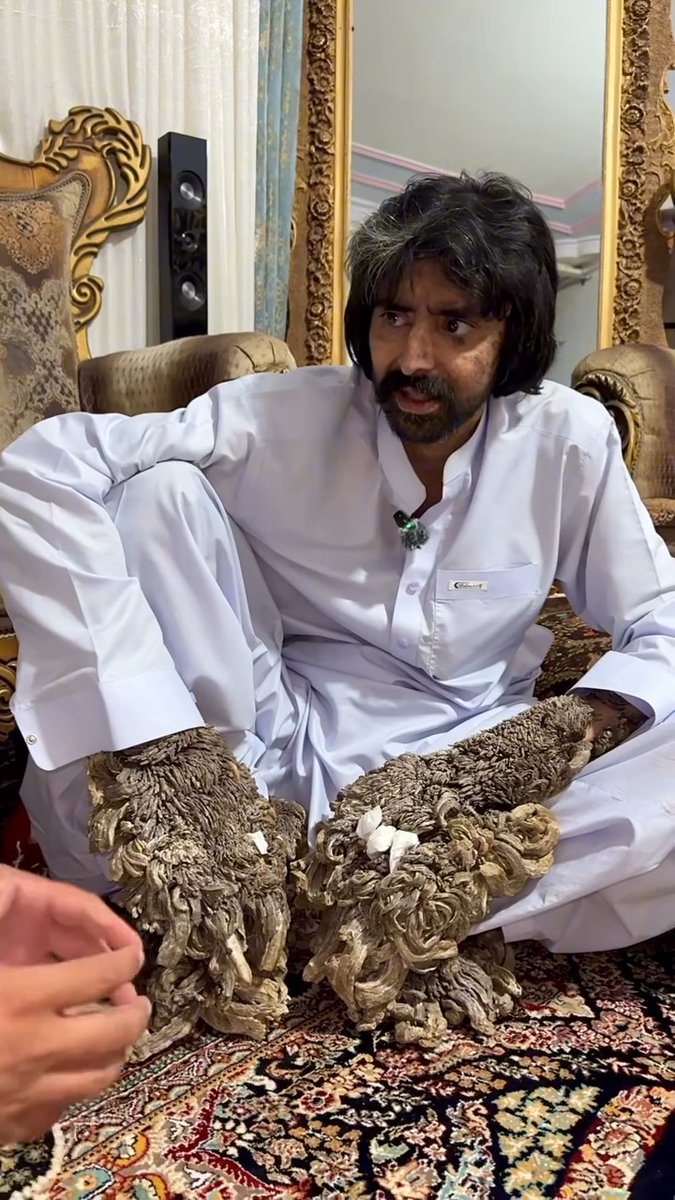 OMG 😱😱😱💔..His body looks like it’s being covered in TREE BARK… 😱 Can you guess the terrifying diagnosis?