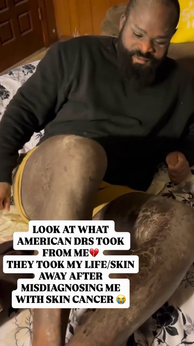 TRENDING 🚨:“Look at what American Doctors took from me. They took my life/skin away after they after misdiagnosed me with skin cancer. “ “I had severe eczema/tsw and they said they "thought" it was skin cancer and treated me for it” — an American socialite has sparked stirs online sharing his troubled skin condition with eczema.