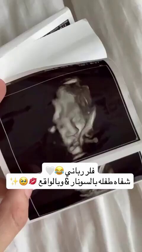 متداول : طفلة تولد بفلر رباني وجمال غير مسبوق🥹❤️