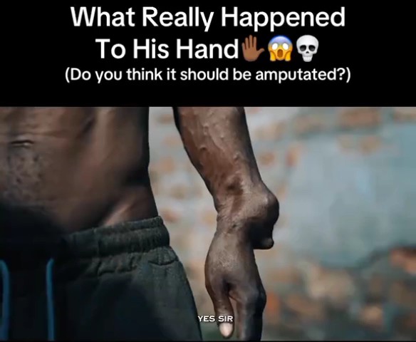 Man shares a sad story on how Police allegedly sh0t him on his hand around Diobu area for trying to help someone. When they later found that he was innocent, they took him to Teme Clinic in Port Harcourt. ~ Port Harcourt Man reveals his ordeal years back in the hands of Police 📹Freme King Production | TT