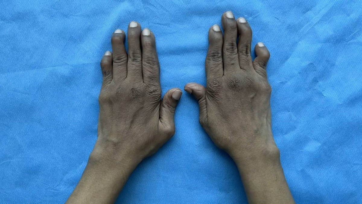 A woman presented with a 2-year history of pain, swelling, and stiffness in the wrists and fingers. When the patient’s hands were clenched into fists or pressed against the table, the joint deformities largely resolved. Read the full case details: