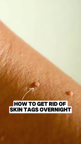 This is how to get rid of skin tags FAST! Dr. Eric Berg, DC, not MD; information only