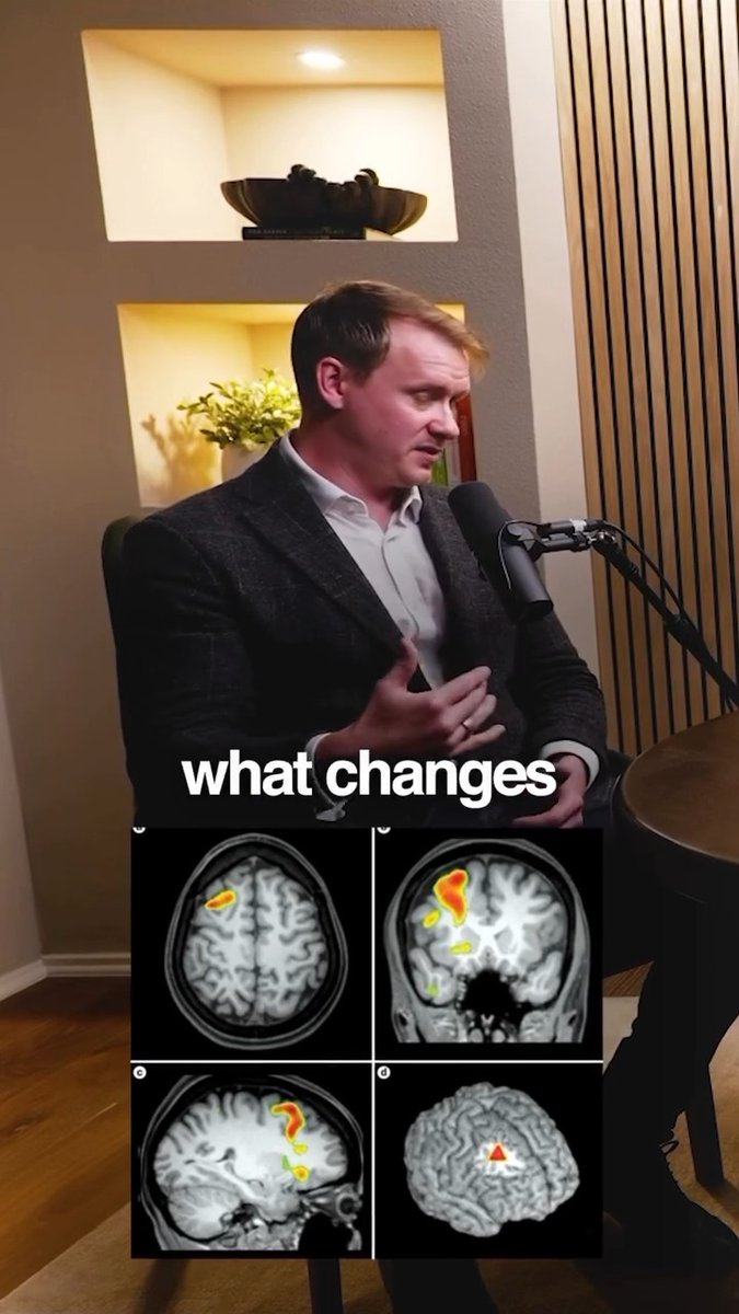 Can a ketogenic diet rewire the brain in bipolar disorder? New research suggests it can, by lowering glutamate, a neurotransmitter that’s often elevated in epilepsy, bipolar, and schizophrenia. That’s why keto was originally used to treat seizures… and now, it’s being revisited as a breakthrough treatment for mental illness. In today’s episode, I talk with Dr. Iain Campbell, neuroscientist, bipolar patient, and lead researcher at the University of Edinburgh, about why mental illness may actually be a metabolic brain disorder. Here’s what we cover: • How bipolar symptoms may stem from mitochondrial dysfunction • Why glutamate matters and how keto affects it • The history of using keto to treat epilepsy and diabetes • What a $3M clinical trial hopes to prove • And how this new science could change psychiatry forever So much more! This conversation will challenge everything you thought you knew about mental health and offer real hope for those who’ve been failed by conventional treatments. Full episode with Dr. Iain Campbell is live on The Dr. Hyman Show Podcast wherever you listen.