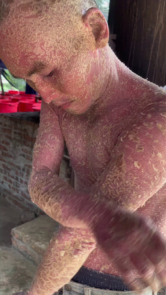 A young man returned from a trip to the forest with his friends. Soon after, he noticed something unusual developing on his back 💀 What’s the most likely diagnosis? Drop your answer below 👇 #MedEd