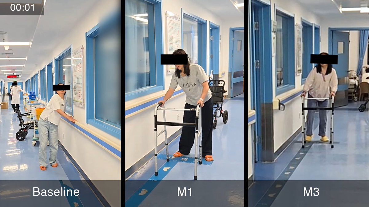 A video shows a patient with progressive multiple sclerosis attempting to walk before and after treatment with JY231, an off-the-shelf lentiviral vector designed for the direct in vivo engineering of CD19-targeted CAR T cells. Learn more in the preliminary results of a phase 1 trial: