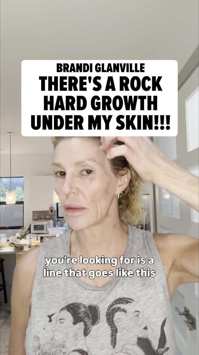 ❤️‍🩹‼️ Brandi Glanville's opening up more about her ongoing health battle ... sharing emotional videos that show the shocking toll her condition has taken on her face and skin.