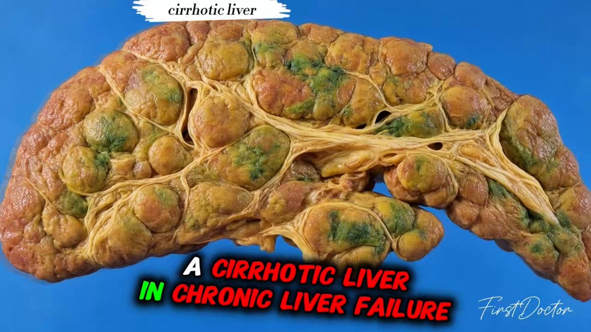Your liver may be failing silently but you don’t know. No jaundice, no tommy pain, no signs. By the time you find out, it has reached an irreversible point called cirrhosis. Here are 8 silent killers of the liver. (Number 4 may be in your kitchen right now):