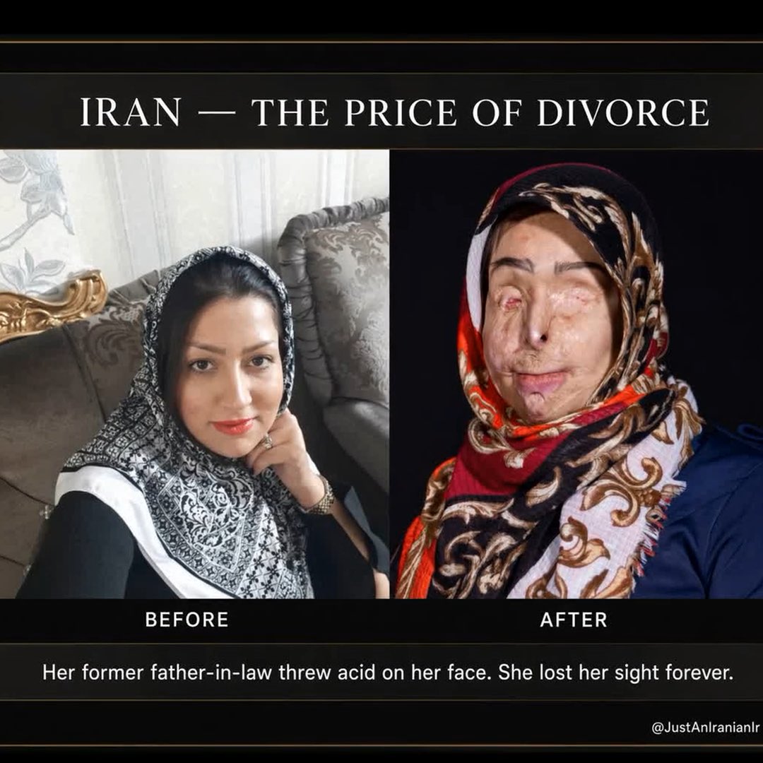 This is what happens in Iran when a woman asks for a divorce. Masoumeh Ataei wanted out of her marriage. Her former father-in-law threw acid on her face. She lost her sight. Dozens of surgeries. She still cannot see. This is not rare. Look. Do not look away.