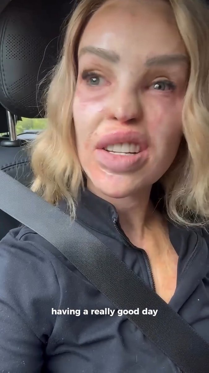 Katie Piper, British TV personality, writer and acid attack survivor, opened up about all of the cruel comments she has been receiving since appearing on the red carpet at the National Television Awards. "I know who I am, and who am I am not, but, do you know who you are?" she wrote, sharing how harmful the internet's behaviour has been and pleading with people to stop policing other's bodies. 📽️ : Katie Piper #bekind