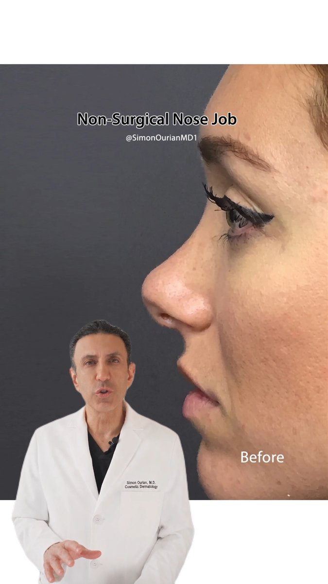 Dr. Simon Ourian reviews the latest insights on non-surgical nose job options to help you understand what may be right for you. If you’re considering a non-surgical nose job, liquid rhinoplasty, or nose filler, the goal isn’t simply to change the shape of your nose—it’s about improving facial balance and proportions based on your unique anatomy, goals, and expectations. A non-surgical nose job uses carefully placed filler to smooth the appearance of a dorsal hump, refine the nose bridge, enhance the tip, improve symmetry, and create a more balanced side profile. It can provide subtle contouring without surgical incisions or the recovery associated with traditional rhinoplasty. The key? Understanding what can realistically be achieved with non-surgical nose contouring. Personalized planning and precise placement can help create natural-looking results that complement your existing features and overall facial proportions. This patient achieved a more refined nose shape and balanced profile with a non-surgical nose job by Dr. Simon Ourian in Beverly Hills. #nosejob #liquidrhinoplasty #nosefiller #drsimonourianreviews #drsimonourian