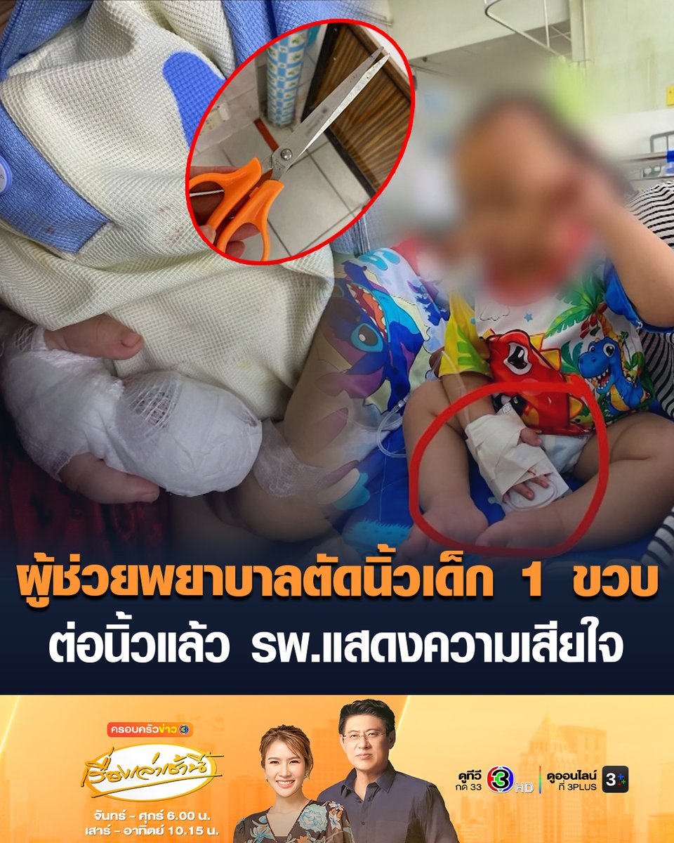 พ่อแม่ช็อก ผู้ช่วยพยาบาลสะเพร่า กรรไกรตัดเทปพันสายน้ำเกลือพลาด เด็ก 1 ขวบ นิ้วขาด หมอผ่าตัด 2 รอบ ต่อนิ้วแล้ว รพ.แจง-แสดงความเสียใจ #เรื่องเล่าเช้านี้ #ครอบครัวข่าว3 #ข่าวสังคม