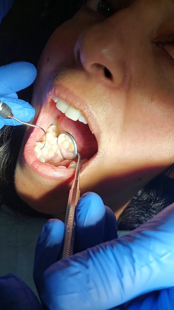 Most teeth in a single socket (female) 🦷 4 by Sylvia Boctor 🇨🇦 Sylvia has three supernumerary teeth and a normal second premolar sharing the same tooth socket.
