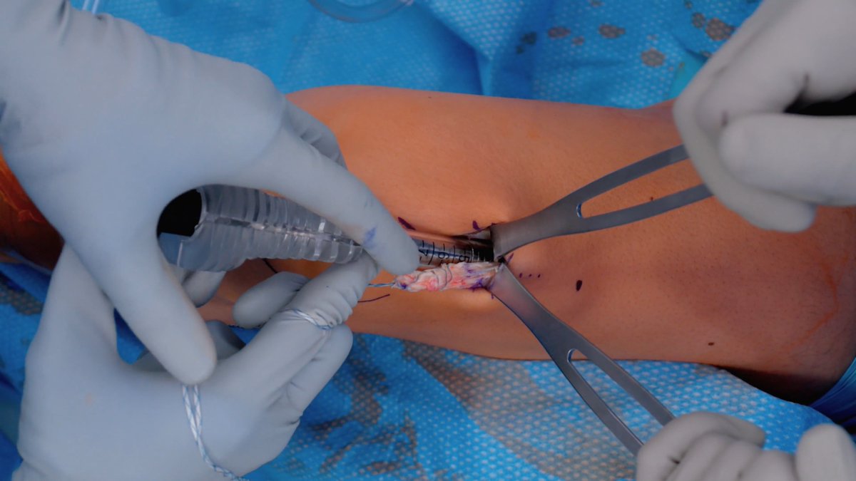 Rachel M. Frank, MD, presents a live case in which she treats a patient with a full ACL tear using the all-suture TightRope® SB implant and a quadriceps tendon autograft. Dr. Frank also discusses her use of the QuadPro™ tendon harvester and reviews graft preparation steps. Learn more about the TightRope SB implant at the 2026 Peds to Pros Knee Symposium on Saturday, November 7. This one-day course includes didactic and lab sessions focused on the newest tools and techniques to treat all athletes, from pediatric players to weekend warriors to pro-level competitors. ▪️ Learn more about Peds to Pros: ▪️ Watch the full video: