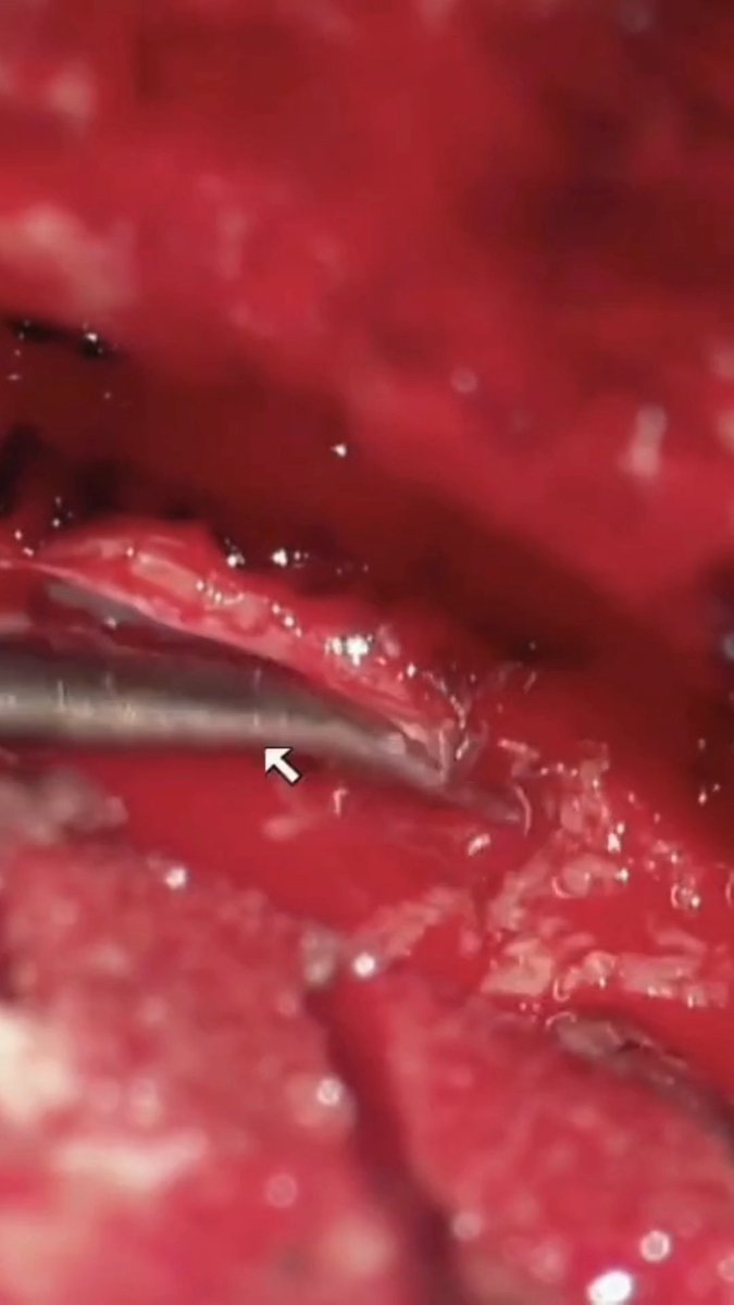 In this operative video, Dr. Cohen demonstrates resection of a cavernous sinus meningioma through a frontotemporal approach. The operation proceeds through the middle fossa, where the fibrous tumor is entered inferiorly and internally debulked to create working space. As the mass is reduced, the dissection follows the lateral wall of the cavernous sinus, with continued attention to the trigeminal nerve branches as they are identified and preserved. Further opening of the lateral cavernous sinus wall allows additional tumor removal until cavernous sinus venous bleeding defines the limit of safe resection. Start your trial with the Neurosurgical Atlas today to gain access to our library of operative videos.