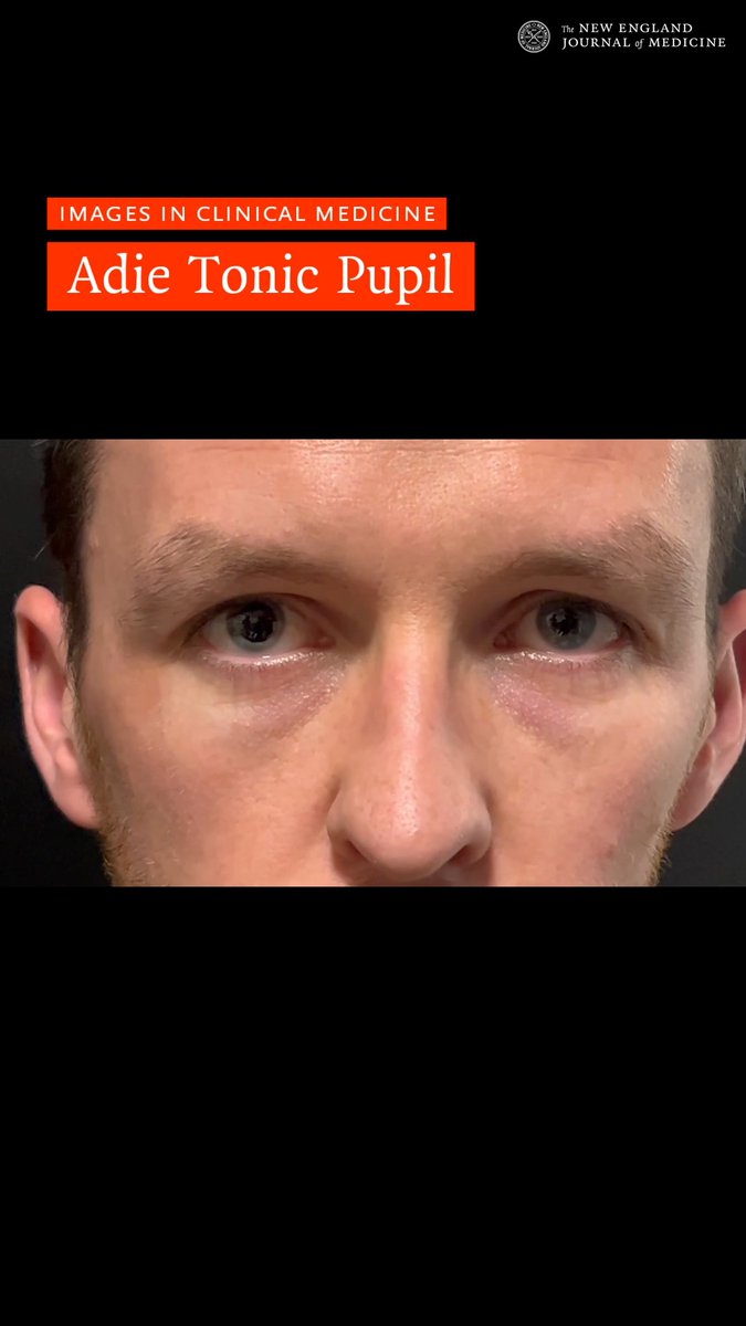 A 36-year-old man presented to the ophthalmology emergency department with a 1-week history of asymptomatic anisocoria. Video 1A shows the pupillary reaction to light, and Video 1B shows segmental vermiform movements. Read the full case details in the Images in Clinical Medicine article “Adie Tonic Pupil”: