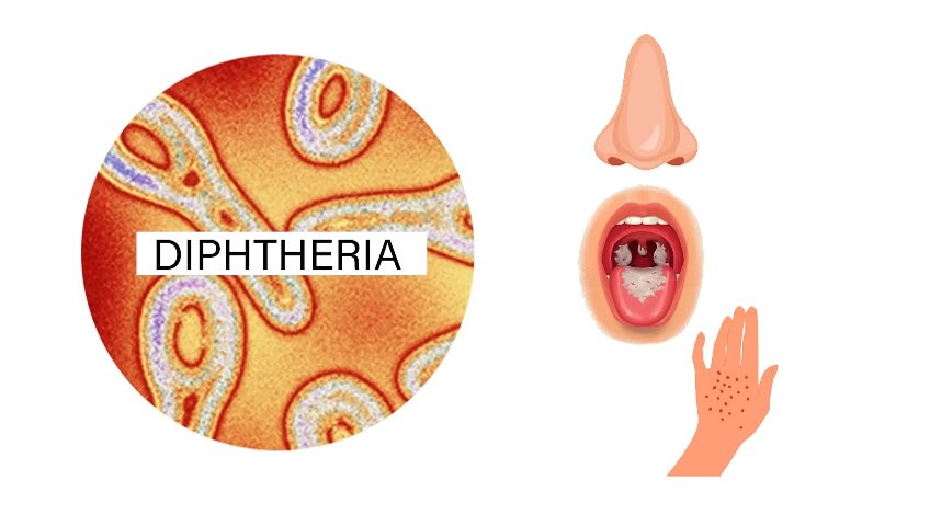 Nigeria is currently experiencing diphtheria outbreaks in several states. Keep informed, keep safe. #dliphtheria #nigeria #publichealth