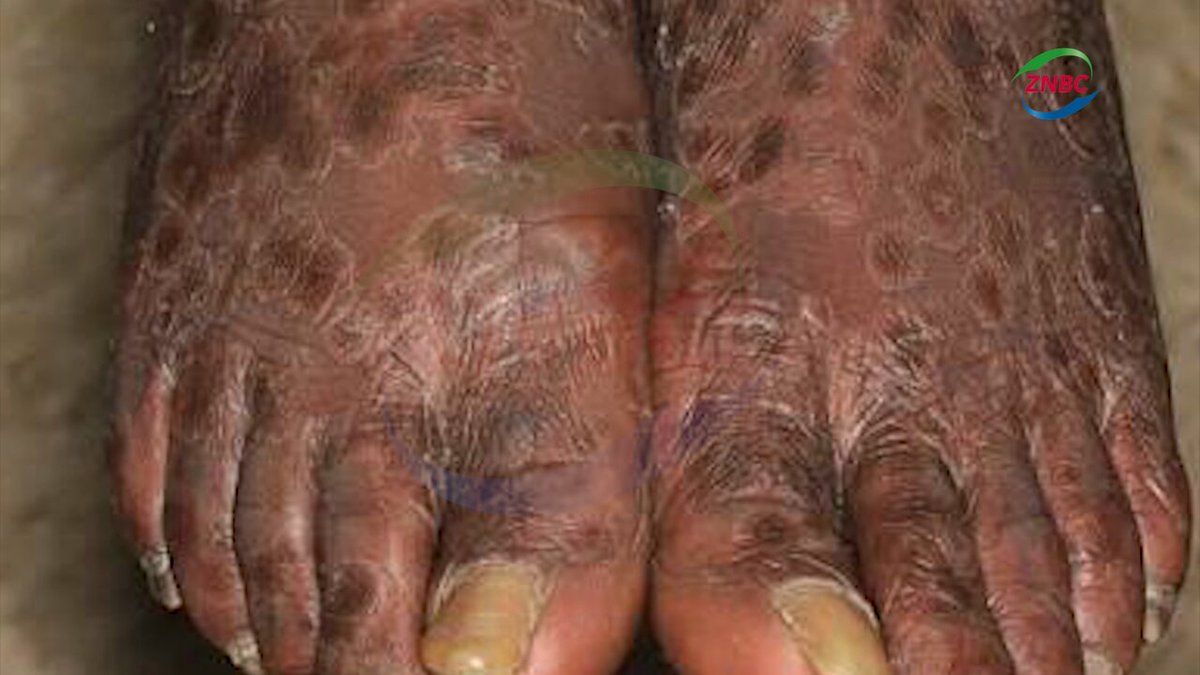 Over Half a Million Syphilis Cases Recorded By Gift Mwanza Zambia recorded more than half a million syphilis cases in 2025, representing a 56 per cent increase in the disease burden since 2021.